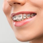 Braces and Nutrition: Foods That Enhance Your Orthodontic Journey