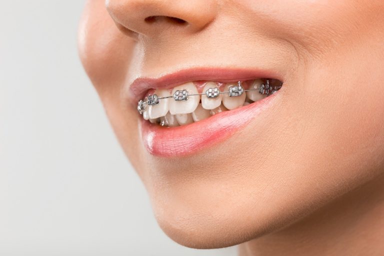 Braces and Nutrition: Foods That Enhance Your Orthodontic Journey